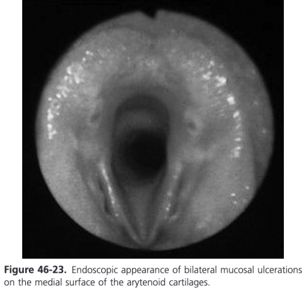 <ul><li><p>Mucosal disease of the arytenoid cartilages in young Thoroughbred horses in Australia and New Zealand has been described</p><ul><li><p>Bilateral kissing lesions are found on or near the vocal processes just proximal to the attachment of the vocal cords</p></li><li><p>Etiology is unknown so this had been termed idiopathic mucosal lesions</p></li><li><p>Manifest as small erosions or ulcer or raised areas of epithelial injury</p></li><li><p>Often hyperemic and can have small, slightly purulent centers</p></li><li><p>Incidence of mucosal lesions in two surveys of Thoroughbred yearlings presented to public auction sales was 0.6%, the incidence of arytenoid chondropathy was 0.21%</p></li><li><p>In a population of racing Thoroughbreds, 2.4% had mucosal lesions</p></li><li><p>These lesions do not affect subsequent racing performance and many heal uneventfully with or without medical therapy</p></li><li><p>Treatment is recommended because in one report, lesions progressed to granulomas in 10% and to arytenoid chondropathy in 5% of the affected horses (Kelly et al, 2003)</p></li><li><p>Broad spectrum antibiotics, NSAIDs, and pharyngeal washes are recommended for 10-14 days</p></li></ul></li></ul>