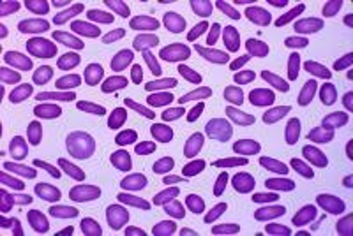 <p>-inherited hemolytic anemia caused by defective alpha / beta spectrin, or protein 4.1 that disrupts horizontal interactions in the RBC cytoskeleton</p><p>-mutations in SPTA1, SPTB and EP41 genes disrupt interactions of the spectrin dimer and destabilize the cytoskeleton, forming elliptocytes</p><p>-symptoms: usually asymptomatic, mild compensated anemia</p><p>-cigar shaped elliptocytes</p><p>-increased osmotic fragility</p>