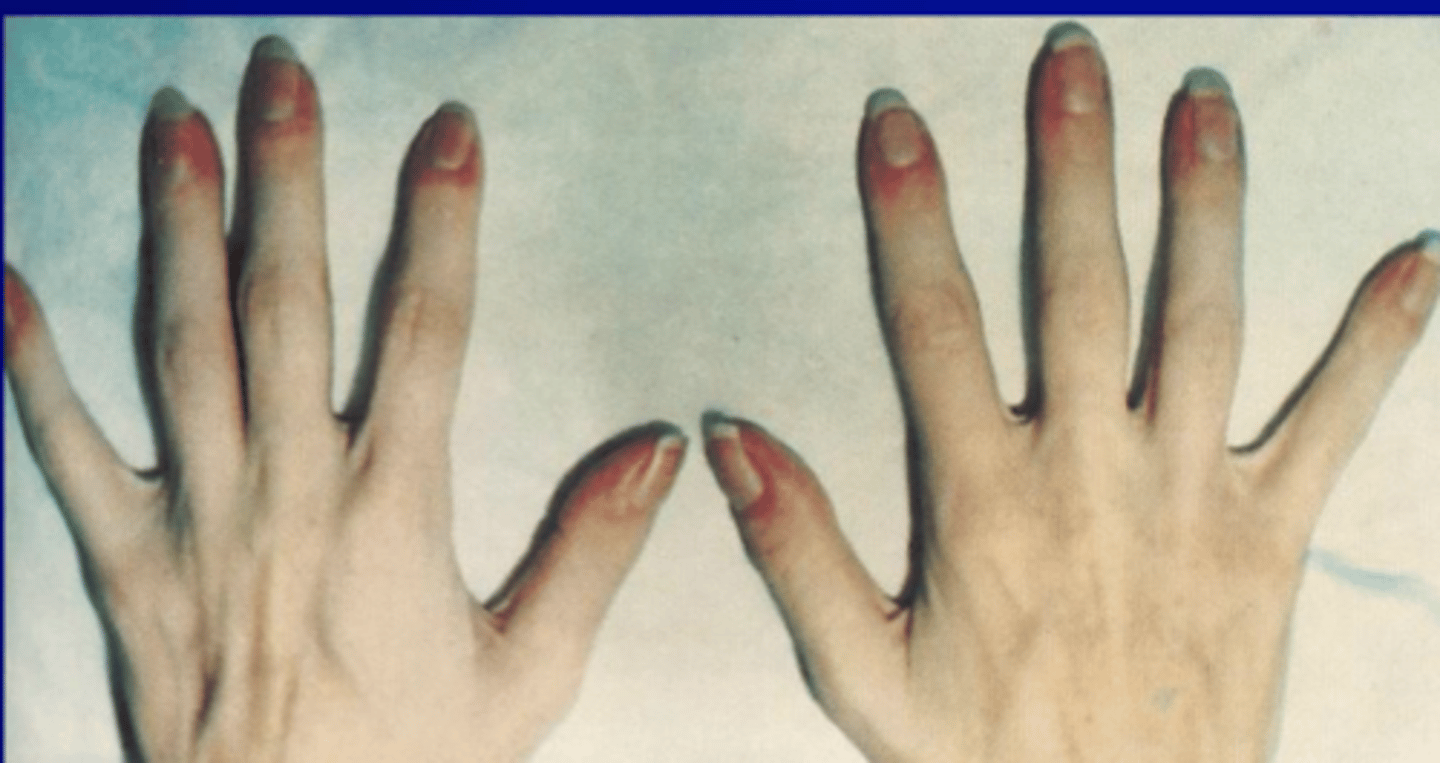 <p>in some pts with longstanding disease</p>