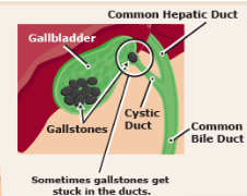 <p>the presence of gallstone in the gallbladder or biliary duct  </p><p><em>but no </em><strong><em>inflammation </em></strong></p>