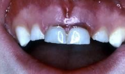 <p>what type of periodontal tissue injury is this</p>