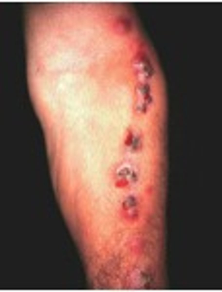 <p>Someone working in the garden gets scratched by some of the plants, and there may be spores from the fungus that will start growing on the person's body. It used the abrasion or damage to the skin as a portal of entry</p>