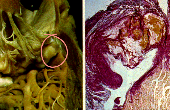 <p>Old peoples disease.</p>