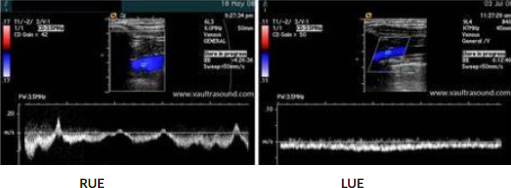 <p>Patient presents with LUE arm swelling x 3 days. Consider waveforms. </p><p>What is the finding? </p>