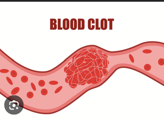 <p>Stroke: Blood clot in the brain</p><p><em>Clot = a clump of blood that blocks blood flow </em>which stops oxygen from reaching brain tissue</p>