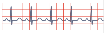 <p>high resting heart rate (above 100bpm) ECG shows little gap between one t wave and next p wave</p>