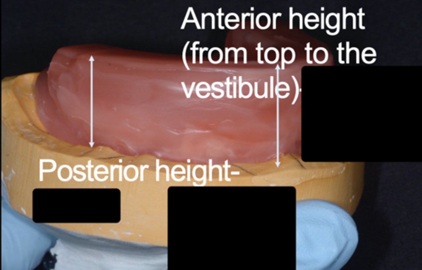 <p>What is the anterior height from the top to the vestibule in the maxillary arch?</p>
