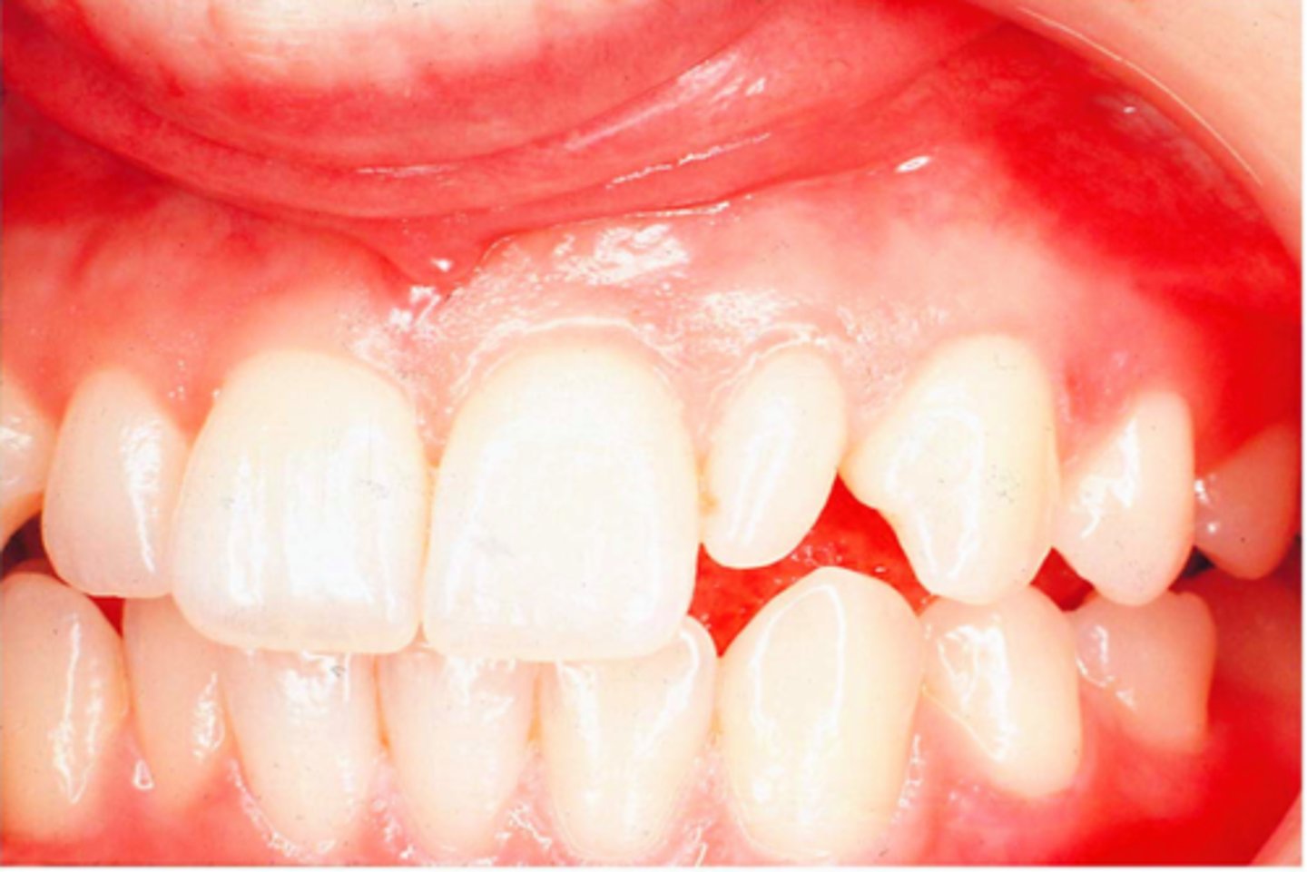 <p>Abnormally small teeth</p><p>- peg lateral (maxillary lateral incisor most common tooth)</p><p>- peg molars</p>