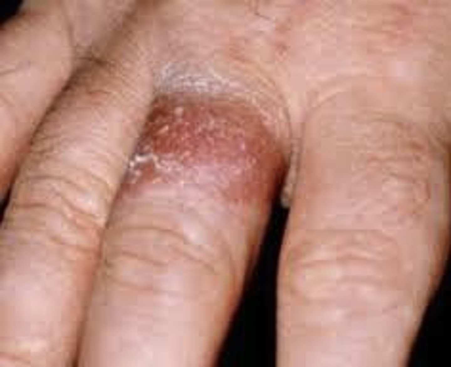<p>diagnose this image:</p><p>this is non-immune modulated, has burning, pruritus, and pain, presents as dry, fissured skin, and is LESS distinct</p>