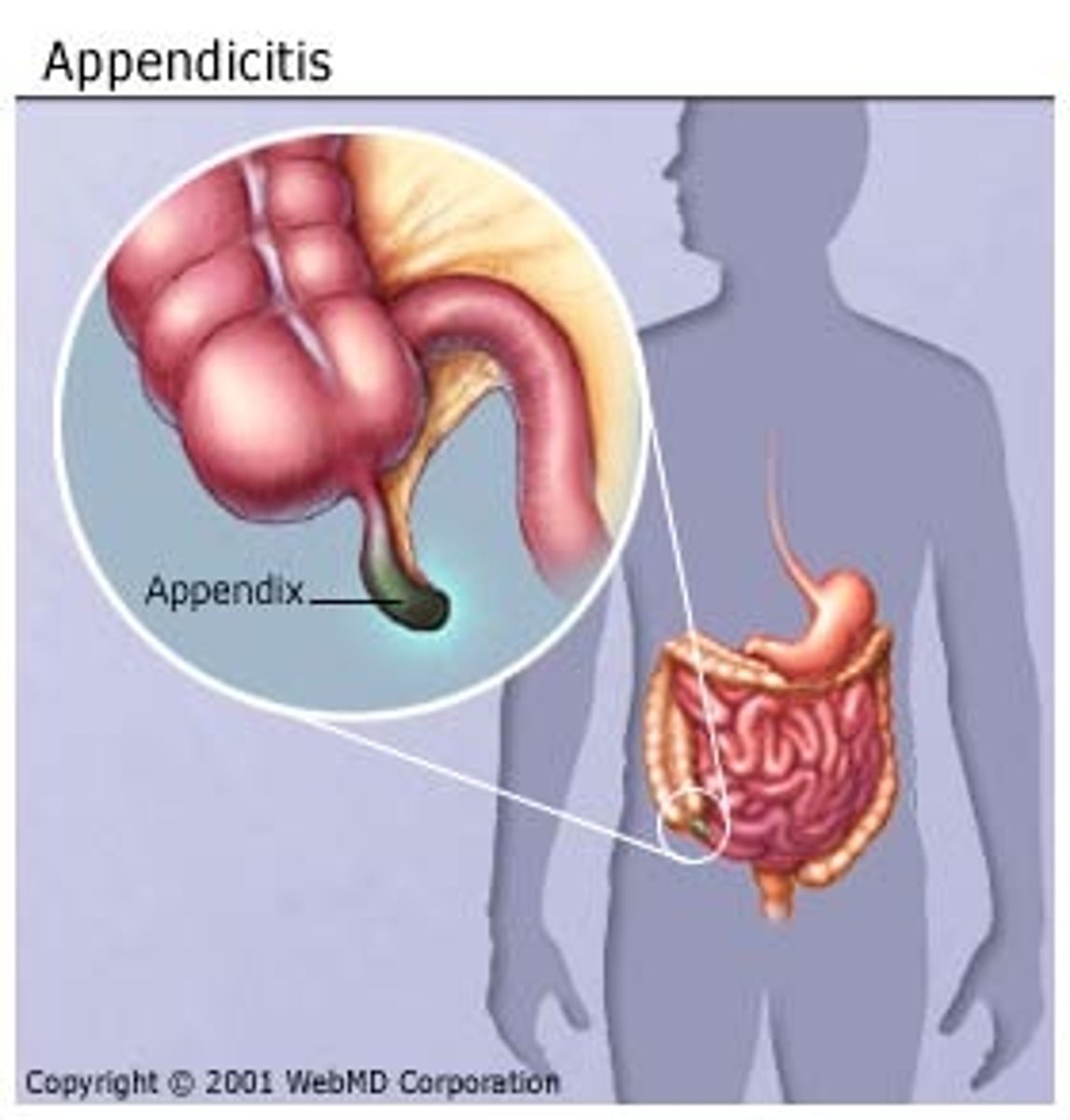 <p>• acute appendicitis is an abdominal emergency</p><p>that occurs when the appendix is obstruction ted by either a fecolith or an enlargement of the lymphoid nodules</p><p>• bacteria can proliferate and invade the appendix wall, causing pressure necrosis</p><p>• localized tenderness in the right groin; begins as a central/periumbilical pain that tends to come and go, and then as the disease progresses, the pain shifts to the lower right groin and is focal. </p><p>• when the appendix first is inflamed, the visceral sensory fibers are stimulated. they enter the spinal cord at the T10 level</p>