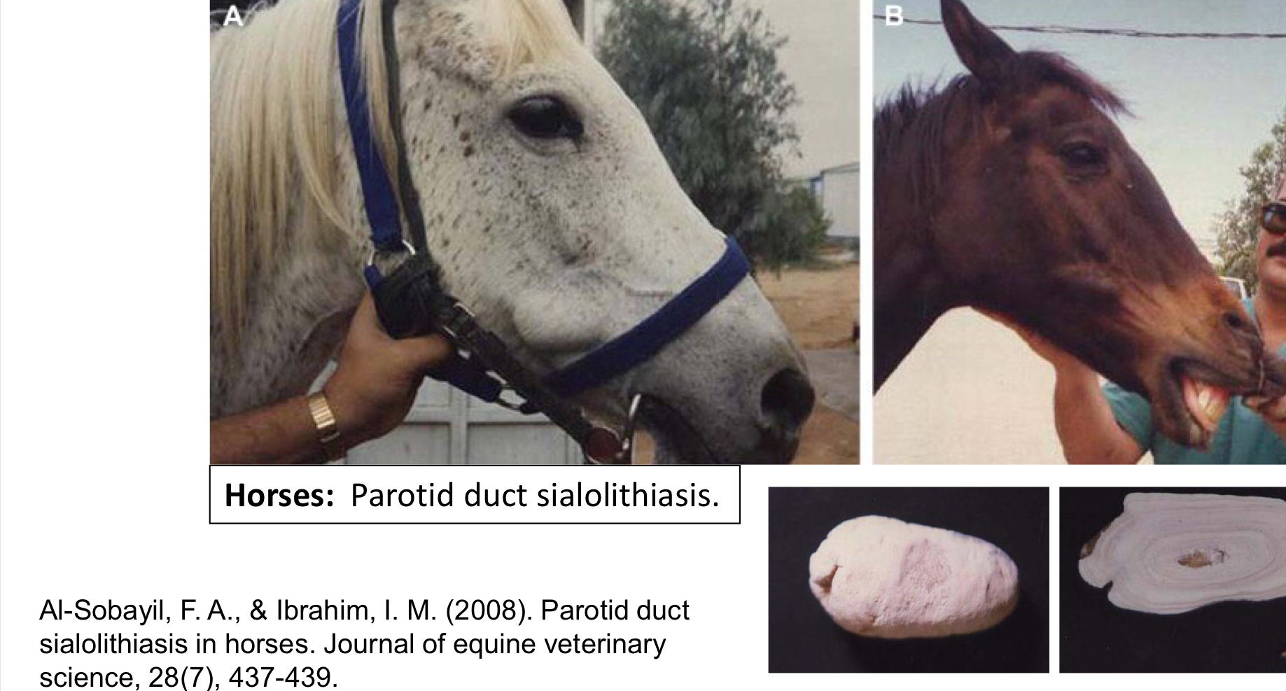 <p>Calculus or stones that form within the salivary gland</p>