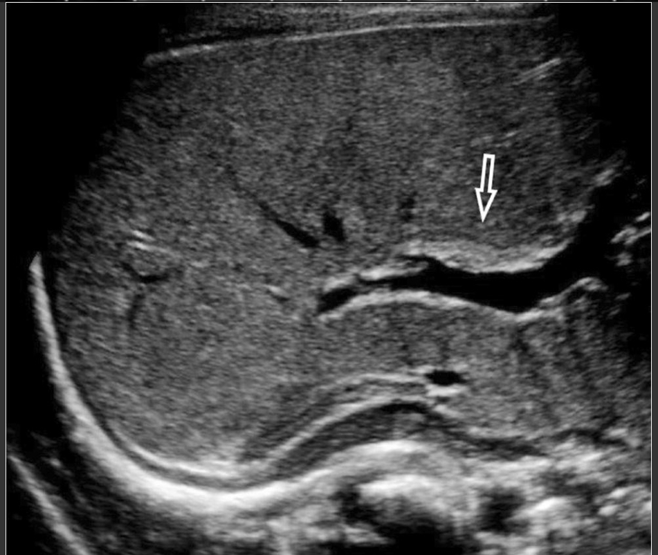 <p>N<span>eonatal absence of biliary ducts; fatal if untreated </span></p><p><span>Absent GB; triangular cord sign; hepatomegaly; minimal/absent intrahepatic duct dilation </span></p>