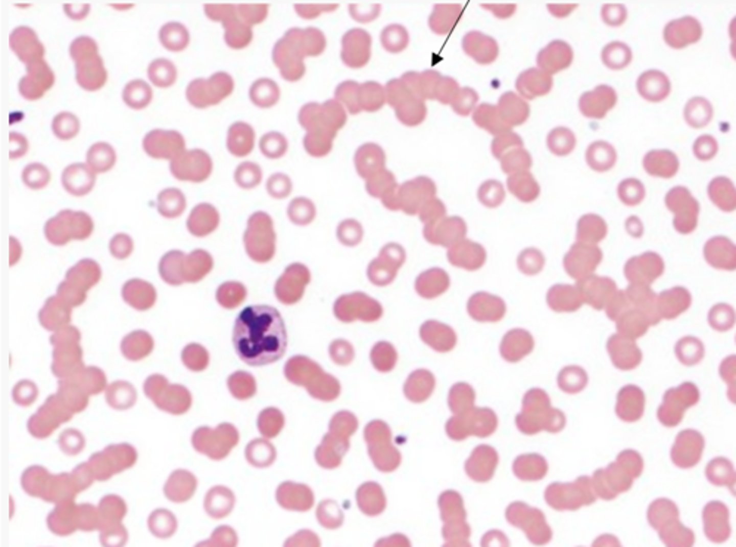 <p>What causes rouleaux formations?</p>