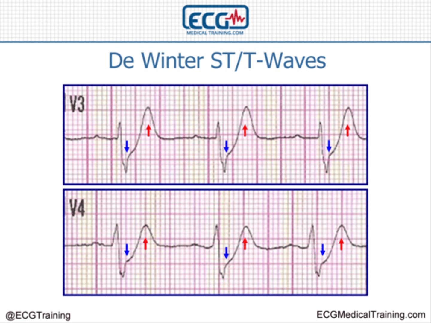 <p>- STEMI equivalent first described in 2008</p><p>- tall symmetric T waves in the precordial leads with upsloped ST depression</p><p>- considered an acute occlusion of the LAD and the patient should have emergent reperfusion (may occur in up to 2% of LAD occlusions)</p>