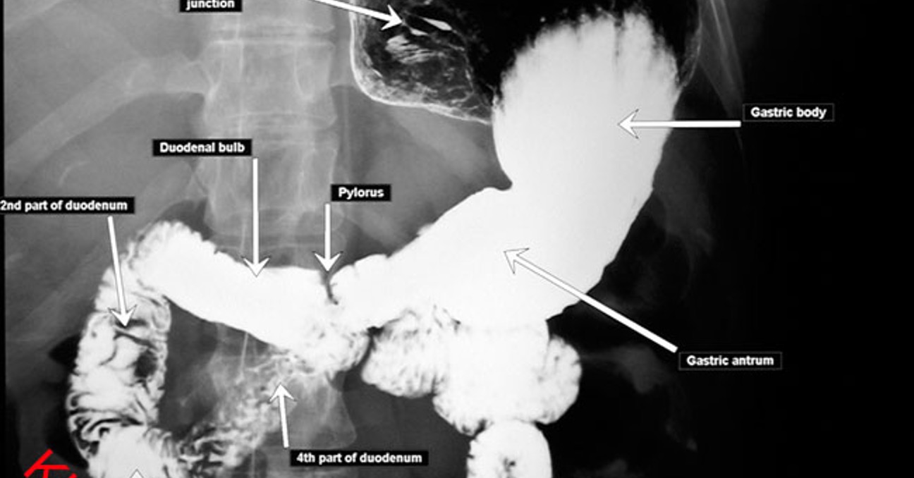 <p>stomach and duodenum</p>