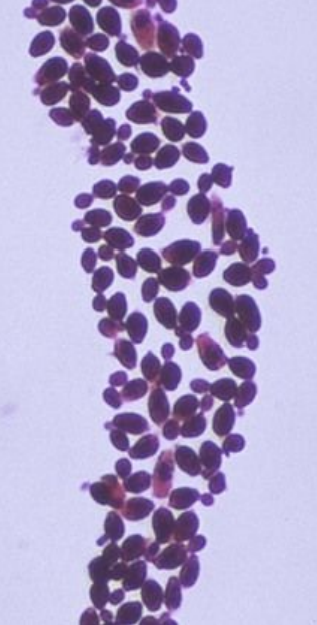<p>8.9 Side B (PBD9: 386; BP9: 502)<br></p>
<p><br></p>
<p>Questions<br></p>
<p>A 22-year-old woman develops vaginal itching and discharge after antibiotics. Gram stain shown.<br></p>
<p><br></p>
<p>1. What organism is present?<br></p>
<p>2. What role did antibiotics play?<br></p>
<p>3. What immune defense is key?<br></p>