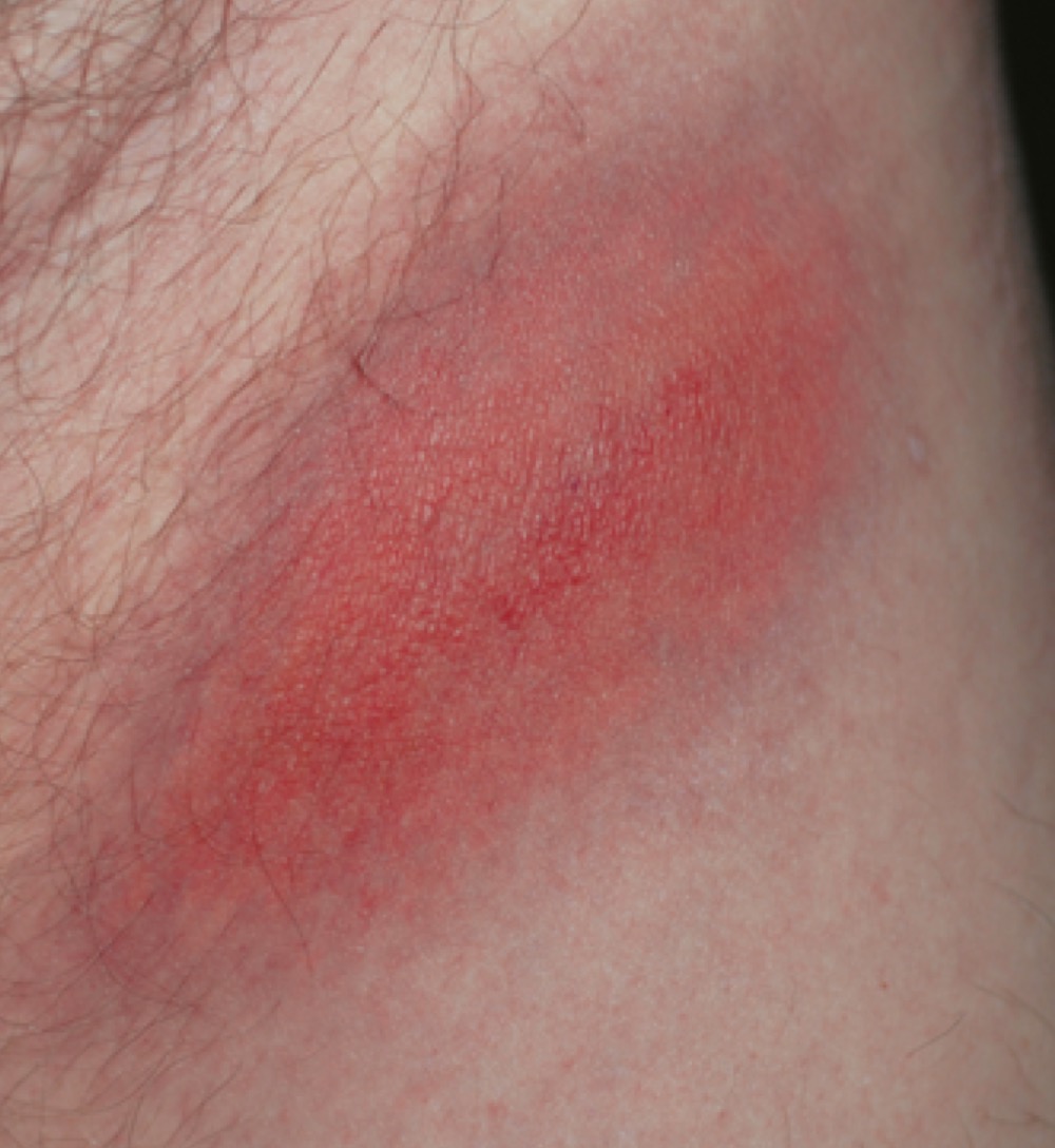 What is this diagnostic of?

A. Cellulitis

B. Impetigo

C. TB

D. Lyme
