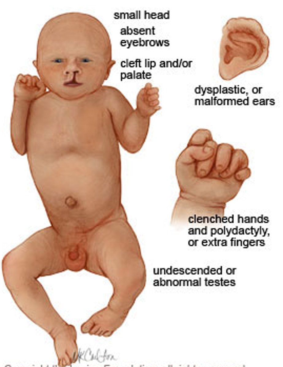 <p>Patau syndrome (Trisomy 13)</p><p>Mnemonic: P=puberty at 13</p>