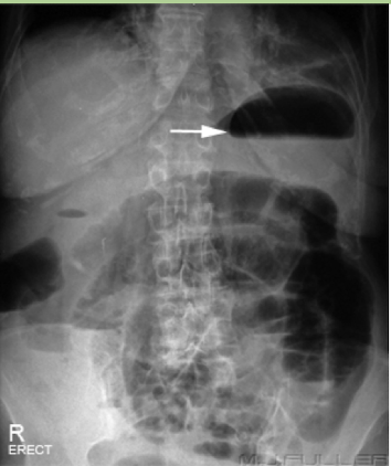<p>common normal finding</p><p><em>Abdominal Radiograph</em></p>