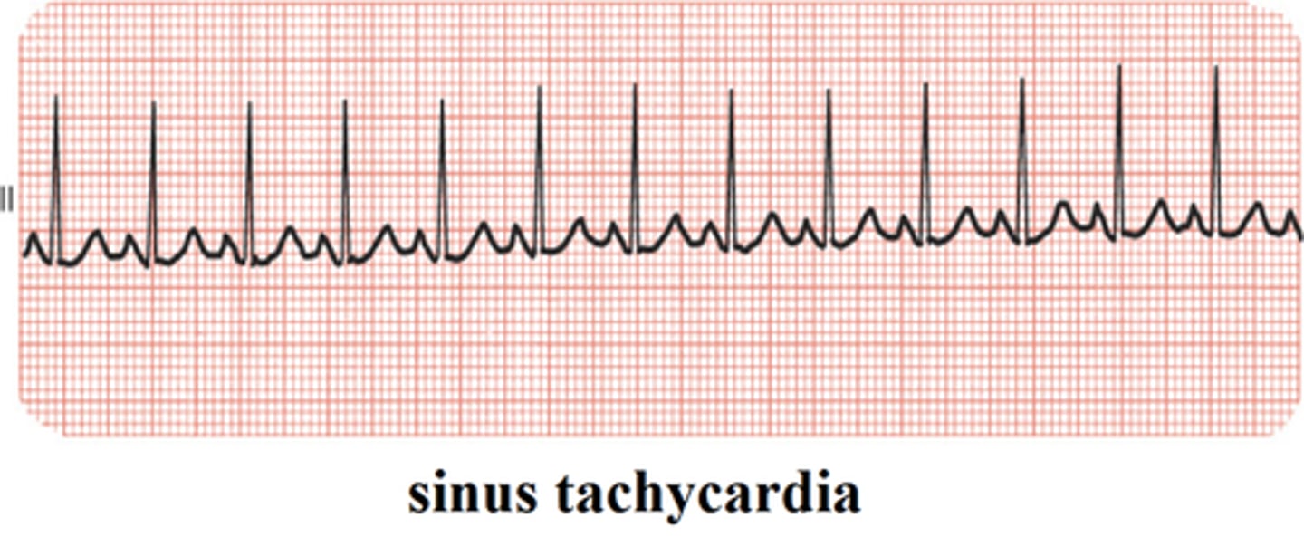 <p>SINUS TACHYCARDIA</p>