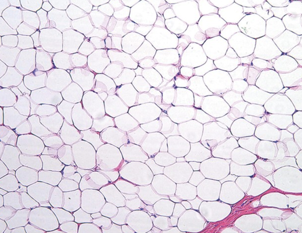 <p><span><span>Describe the gross appearance.</span></span></p><p style="text-align: left;"><span><span>What is the cell of origin?</span></span></p><p style="text-align: left;"><span><span>What is the diagnosis?</span></span></p><p style="text-align: left;"><span><span>What is the malignant counterpart called?</span></span></p>