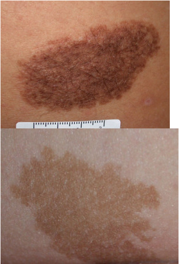 <ul><li><p>oval/round plaque w/ or w/o coarse terminal dark brown or black hair</p></li><li><p>tend to extend deeper into dermis and SC tissue</p></li><li><p>small: < 1.5 cm</p></li><li><p>medium: 1.5-19.9 cm</p></li><li><p>large: > 20 cm; typically have satellite lesions</p></li><li><p>grows proportionally w/ child</p></li></ul><p></p>