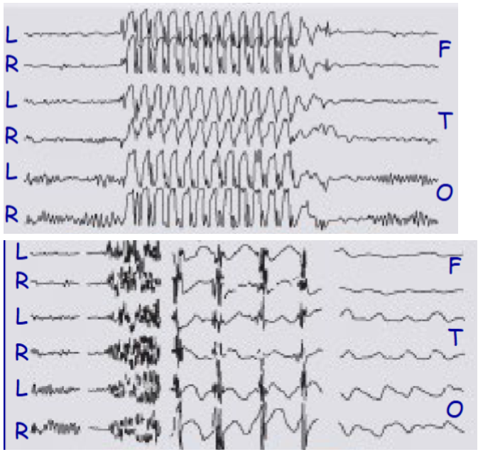 <p>which one of these represents an EEG of a tonic-clonic seizure or an absent seizure</p>