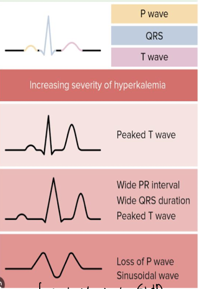 <p><strong><u>what do we se on an EKG for hyperkalemia (start seeing if K over 5.5, life threatening K is over 7)</u></strong></p>
