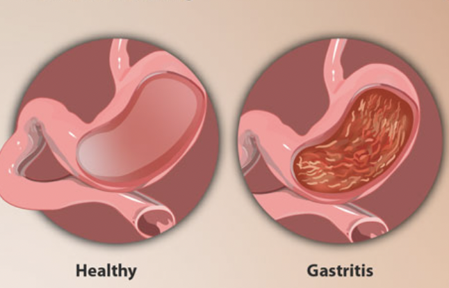 <p>Gastritis (gastr-)</p>