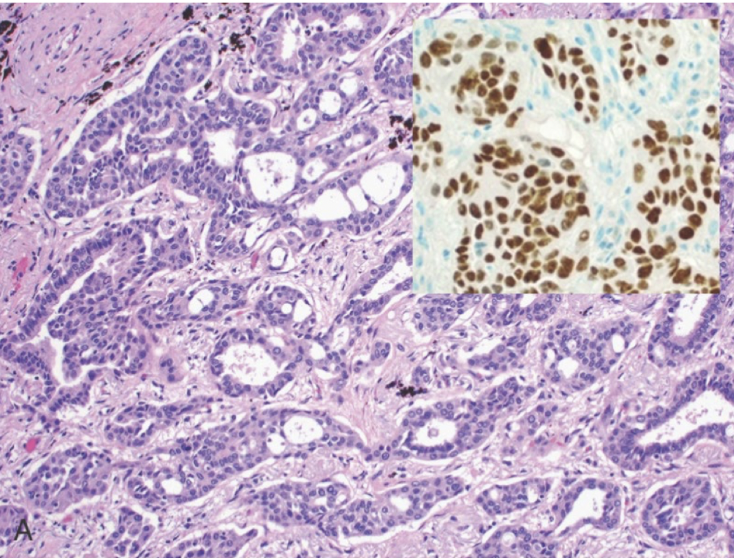 <p>TTF1+ IHC</p>
