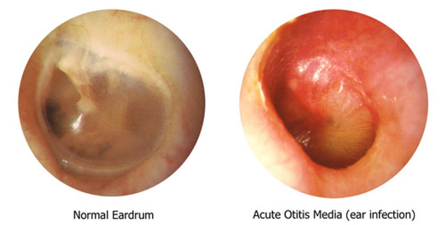 <p>describe structures: handle of malleus, short process of malleus, pars flaccida, pars tensa</p><p>inspect for: color, contour, cone of light</p><p>tympanic mobility: assess w/ pneumatic otoscope</p>