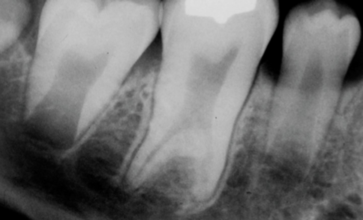 <p>"Bull Tooth". Rare development disturbances of a tooth-isolated normally. Body is enlarged at the expense of the roots.</p><p>-Enlarged pulp chamber, apical displacement of the pulpal floor, lack of constriction at the CEJ.</p><p>More common in Down Syndrome clients.</p>