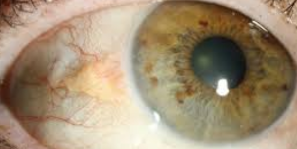 <ul><li><p>Small lump on the bulbar conjunctiva adjacent to the limbus&nbsp;</p></li><li><p>More <u>common on </u><span style="color: red"><strong><u>Nasal</u> </strong></span>side but <u>CAN have on both sides</u></p></li><li><p><span style="color: red">Typically Bilateral but Asymmetric </span></p></li></ul><p></p>