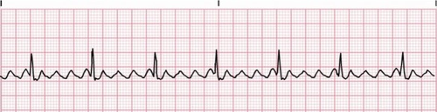 <p>Rapid succession of back-to-back atrial depolarization (QRS complex every 2nd or 3rd wave) producing a sawtooth pattern</p>