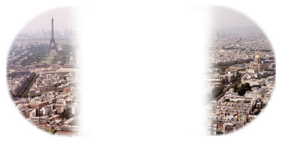 <p><span><span>Inner (nasal) halves of (hemifields) BOTH eyes</span></span></p><p><span><span>damage: </span></span><span>Uncrossed fibers (calcified carotid arteries); hydrocephalus</span></p>