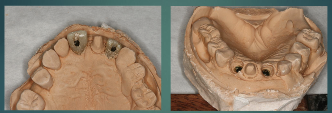 <ul><li><p>remove provisional crown from stone cast, clean/sterilize before re-seat in pt </p></li><li><p>evaluate master cast </p></li></ul><p></p>