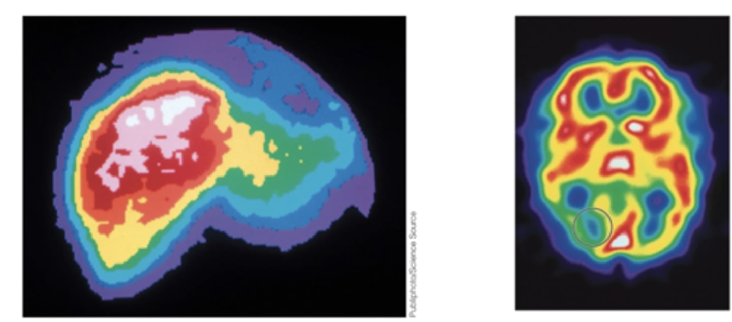 <p>The patient is injected with a radioactive substance that directly emits gamma rays that are detected to study activity of a tissue or organ such as tumors in body tissue</p>