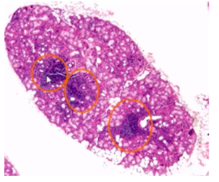 <p><span style="background-color: transparent; font-family: "Times New Roman", serif;">- harvest minor salivary glands from incision on lower labial mucosa</span></p><p><span style="background-color: transparent; font-family: "Times New Roman", serif;">- 1+ foci of chronic inflammatory cells (50+ lymphocytes & plasma cells) adjacent to normal=appearing acini per 4mm2</span></p>