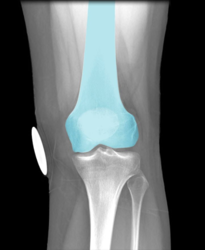 Head forms part of hip joint
Distal end forms part of knee joint