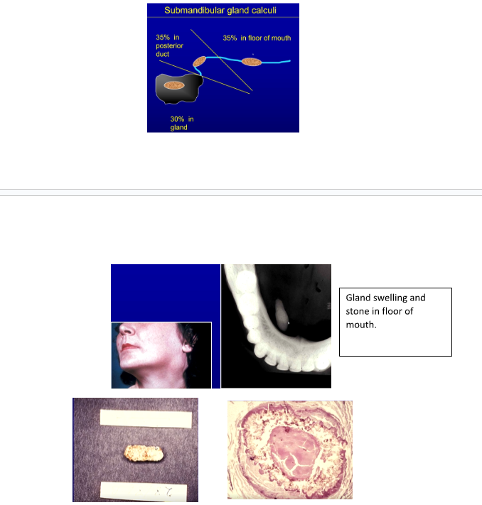 <ul><li><p><span style="background-color: transparent;">Submandibular gland ~80% of the time.</span></p></li><li><p><span style="background-color: transparent;">Parotid 20%.</span></p></li><li><p><span style="background-color: transparent;">Minor Glands 1-15%.</span></p></li></ul><p></p><p>More in submandibular as its only gland pushing saliva against gravity → saliva pools. duct has bends in it</p><p></p>