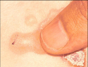 <p>Gentle finger pressure with movement on clinically normal mucosa can produce acleavage in the epithelium and result in the formation of a bulla</p>