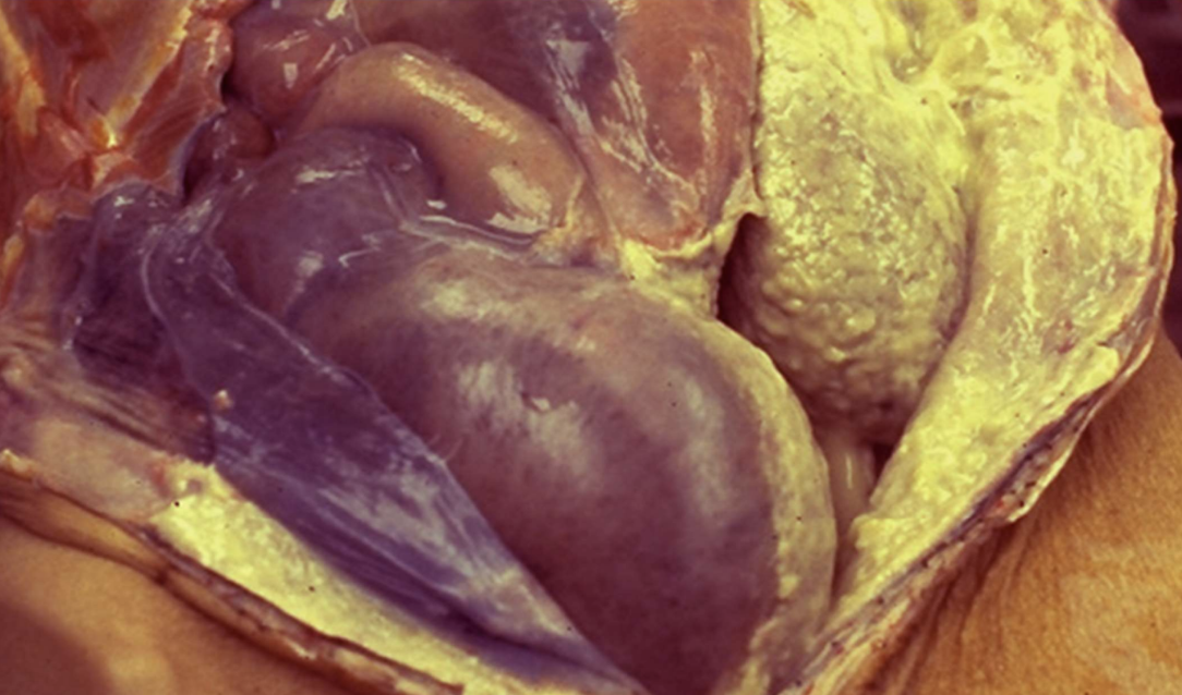 <p>Inflammation with <strong>pus</strong>, dominated by dead neutrophils and debris; can form abscesses.</p><p>Typically caused by staph and strep</p>