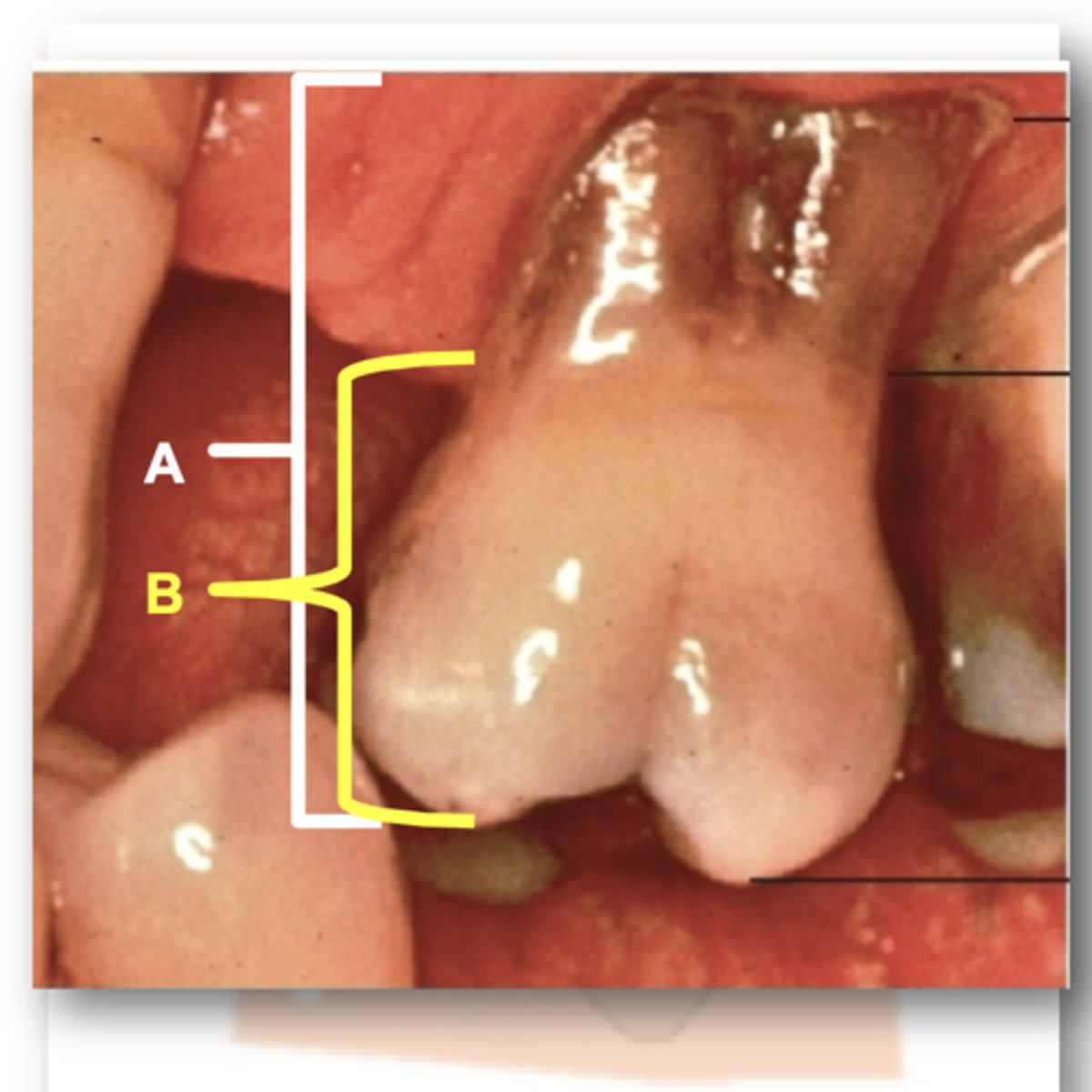 <p>-amount of tooth exposed occlusal to the gingiva</p><p>-may change due to gingival level, eruption, wear</p><p>Picture: A</p>