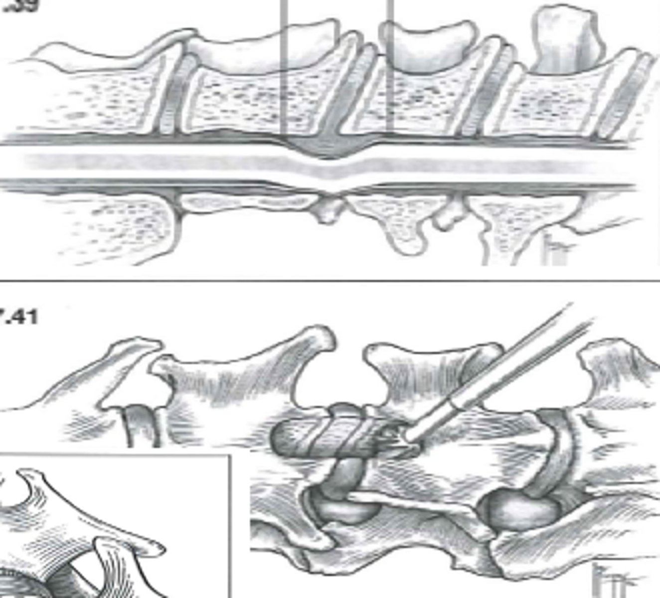 <p>Ventral slot (move trachea, esophagus etc out of the way)</p>