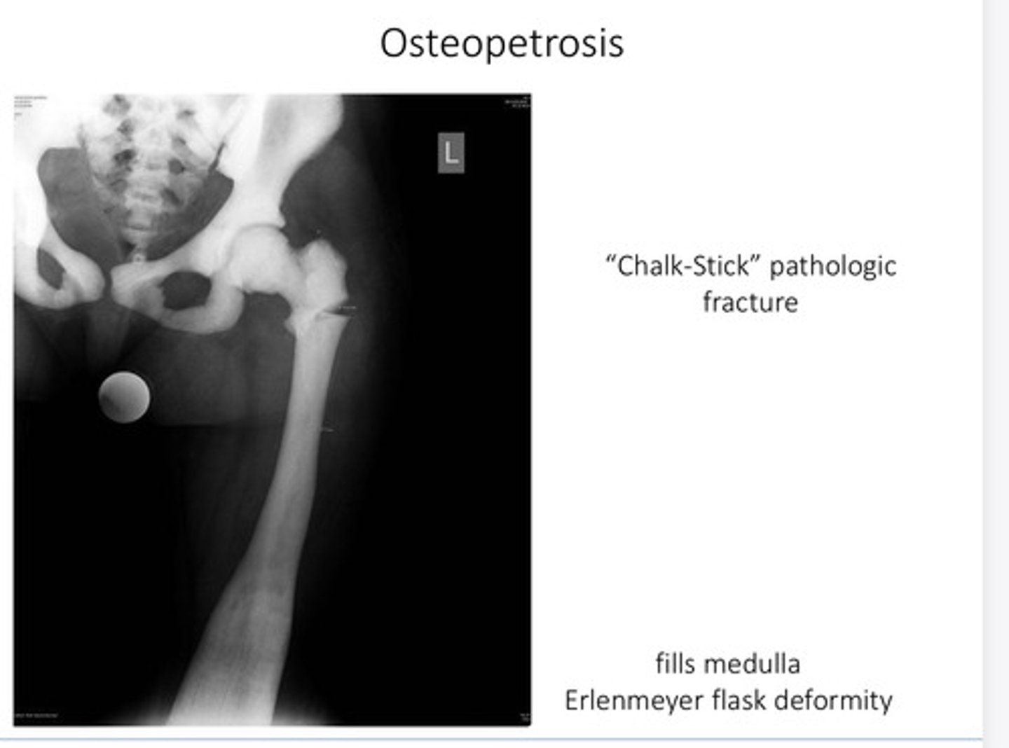 <p>• Skeletal sclerosis (↑ density of bone)</p><p>• fractures: brittle</p><p>• Bony stenosis = cranial nerve palsies</p><p>• Deranged hematopoiesis</p><p>• fatigue &amp; infections</p>