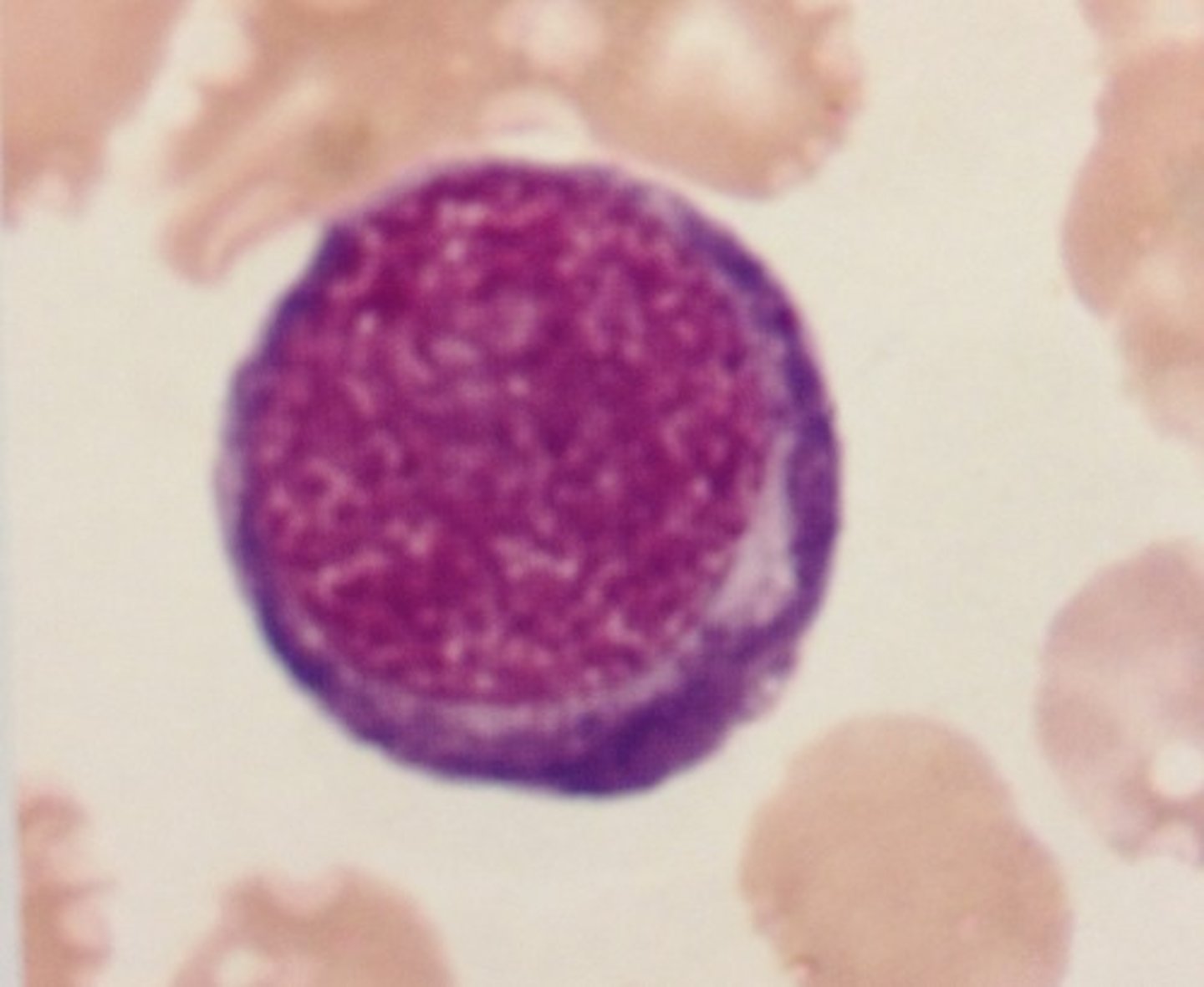 <p>Pronormoblast/ rubriblast/ proerythroblast<br>-80% nucleus<br>-Needs EPO<br>-deep blue cytoplasm and loose nucleus<br>-1% BM</p>