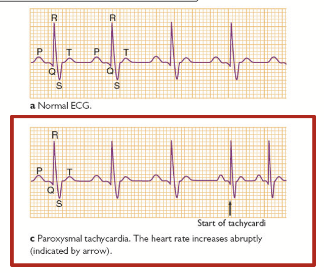 <p>Occurs when a short circuit rhythm develops in the upper chamber of the heart. Heart rate increases abruptly.</p><p>→ a fit, attack, or sudden increase or recurrence of symptoms.</p>