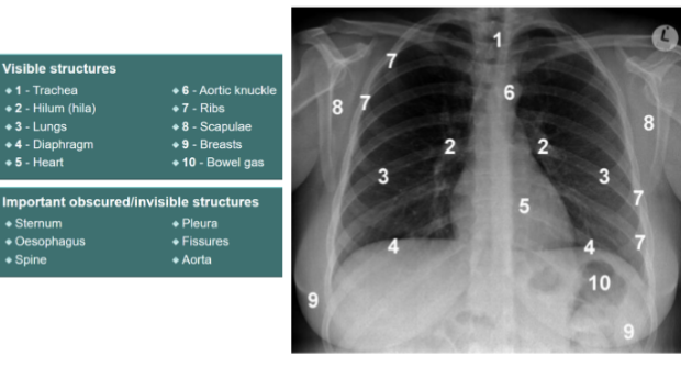 <p>1) trachea 2) hilum- should have R and L 3) lungs 4) diaphragm 5) heart 6) aortic knuckle 7) ribs 8) scapulae 9) breasts 10) bowel gas </p>