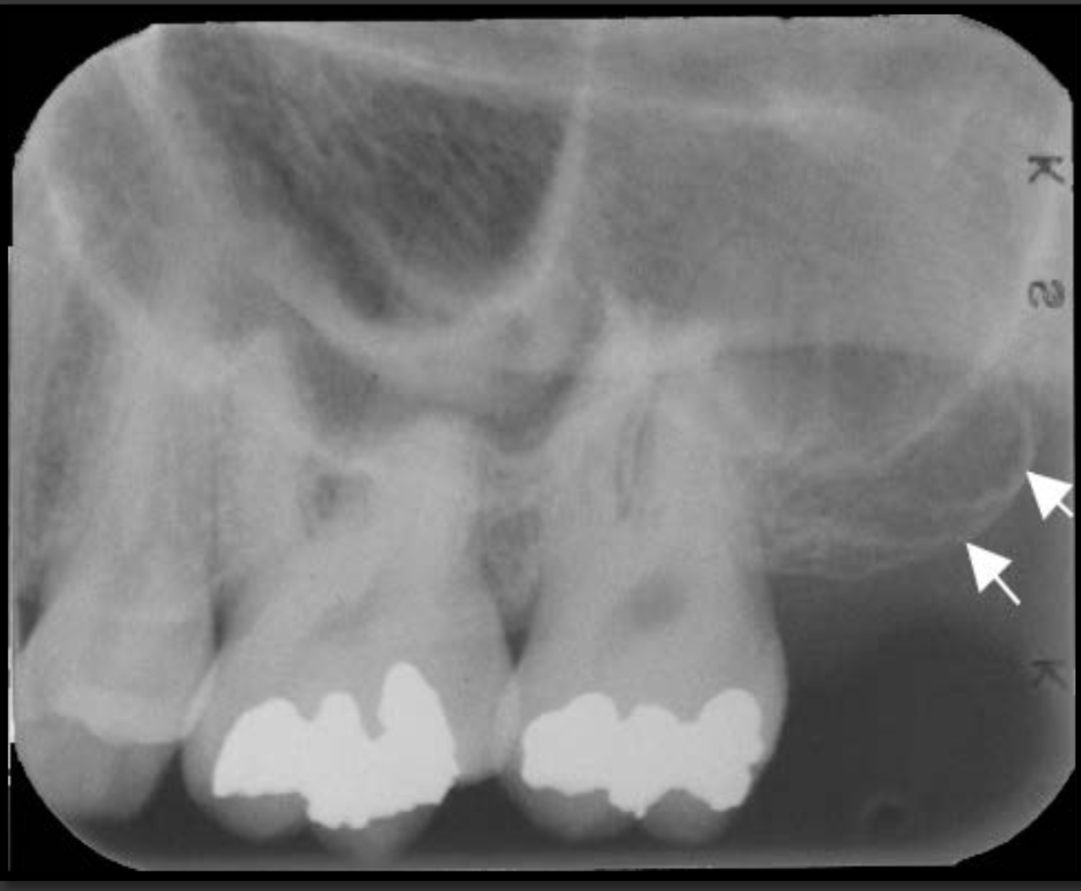 <p>It is the rounded segment of maxillary bone that sits immediately behind the molars. Radio opaque bulge</p>