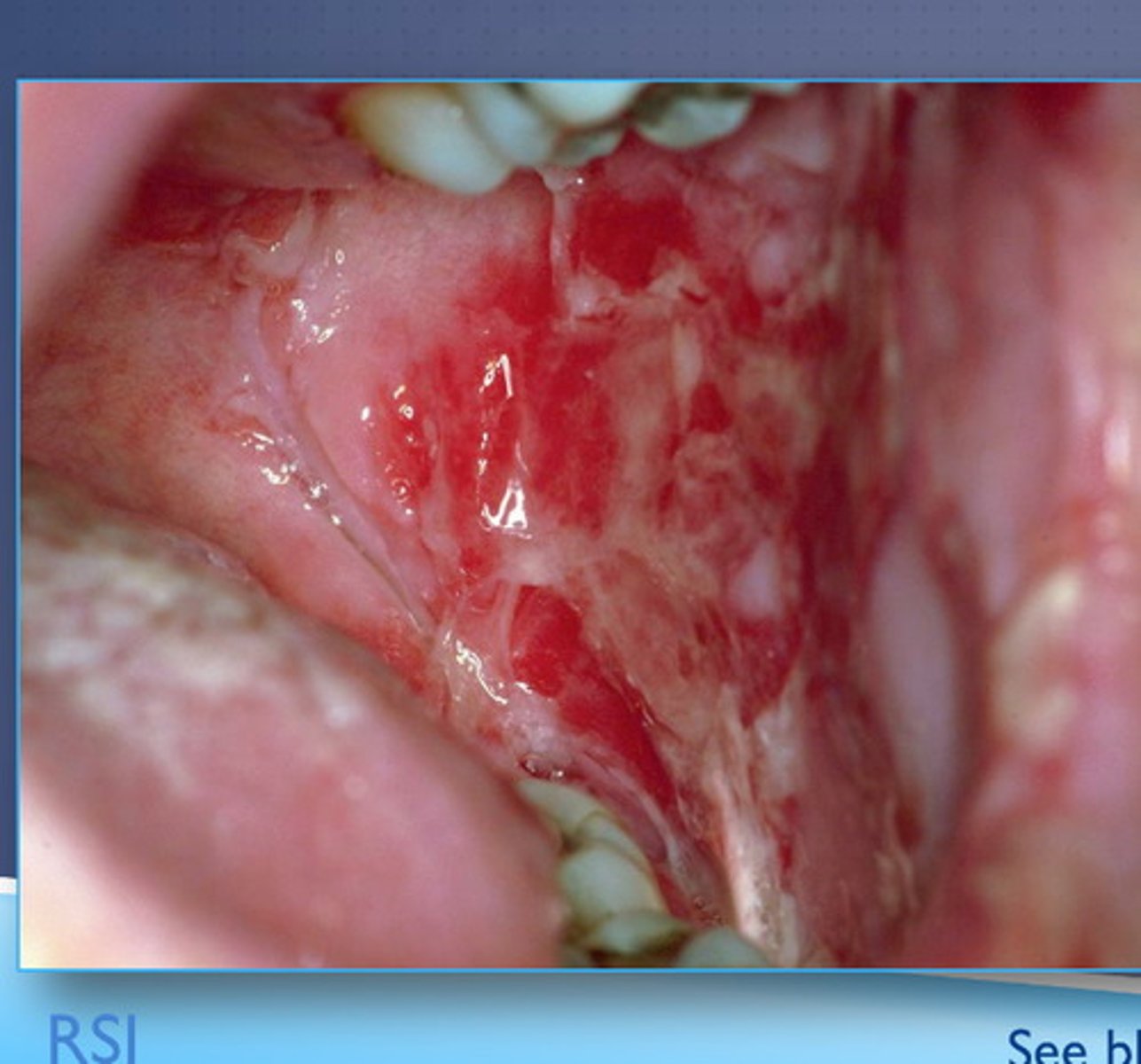 <p>Rare autoimmune disorder of the skin.</p><p>Oral erosions and lesions may appear before a diagnosis</p><p>May be fatal without treatment-high fatality rate</p><p>Fragile bullae on skin-thin and ruptures easily</p><p>Extensive mucosal involvement-similar to Steven Johnsons syndrome</p><p>Difficulty swallowing</p>